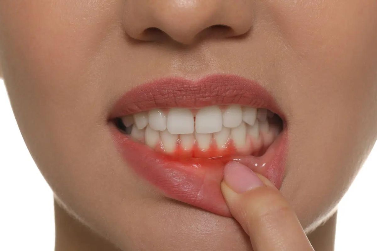 5 Signs of Gum Disease
