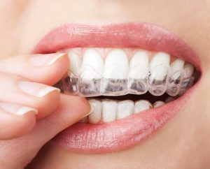 Person inserting clear dental aligner tray into mouth for teeth straightening treatment.