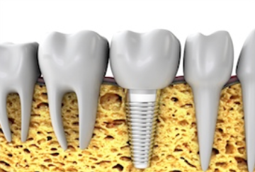 Dental implant diagram showing titanium implants and natural teeth in jawbone cross-section.