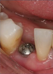 Dental implant placement in jawbone between two natural teeth, intraoral view.