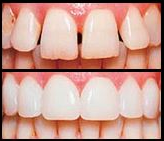 Before and after dental veneers showing improved tooth alignment and whiteness.