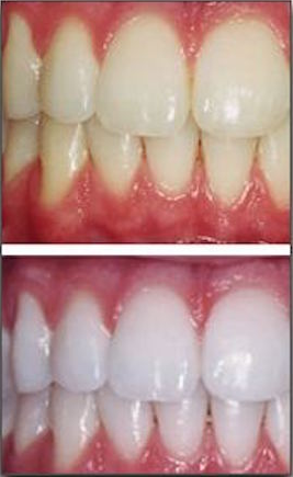 Before and after dental whitening treatment showing brightened tooth shade improvement.