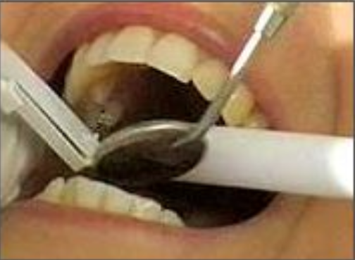 Dental procedure showing dentist using suction tool inside patient's open mouth during treatment.