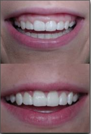 Before and after comparison of teeth whitening results showing brighter, whiter smile.
