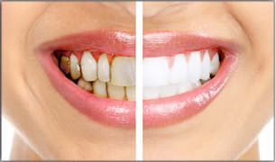 Before and after teeth whitening comparison showing discolored and brightened smile results.