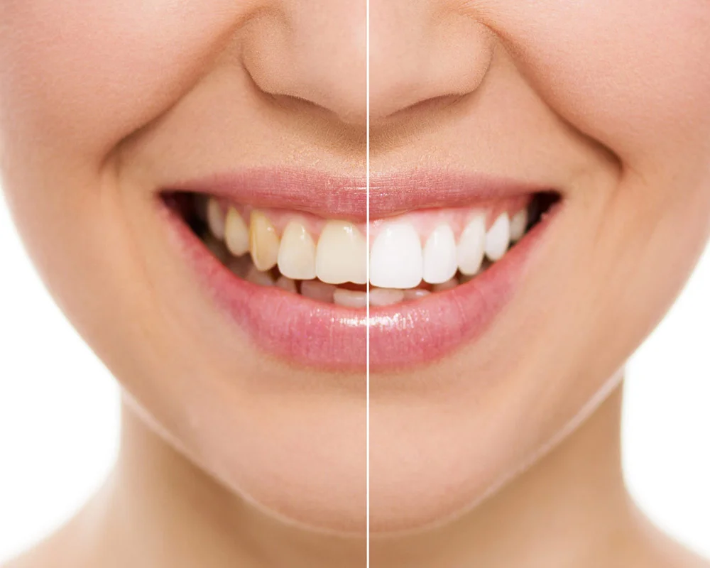 Before and after smile comparison showing teeth whitening results on a person's lower face.