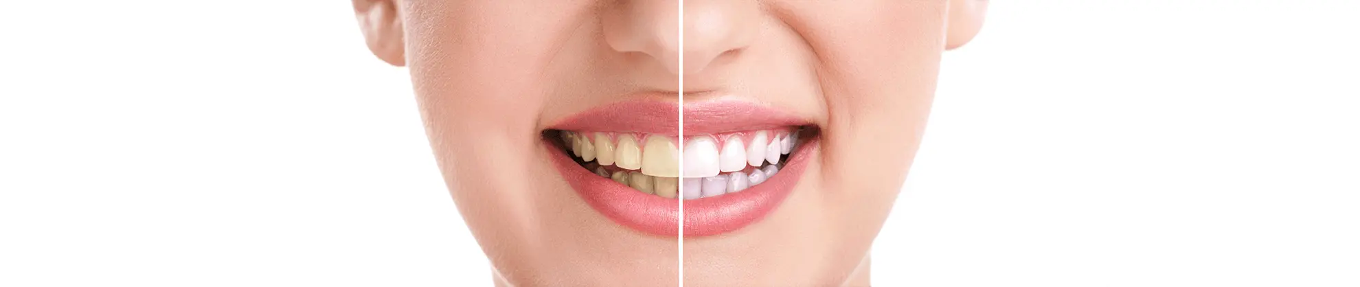 Close-up of smiling person's face showing healthy teeth and dental health results.