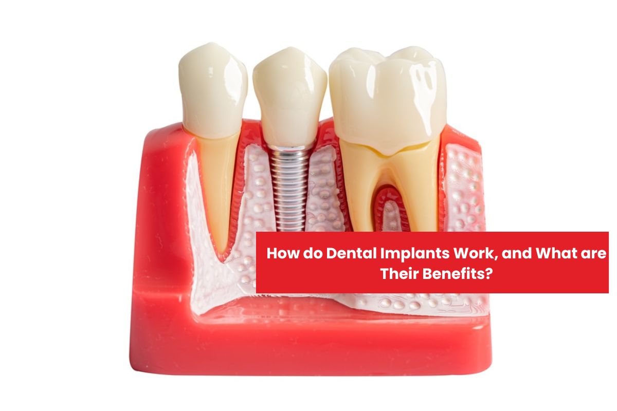 Dental Implants Work