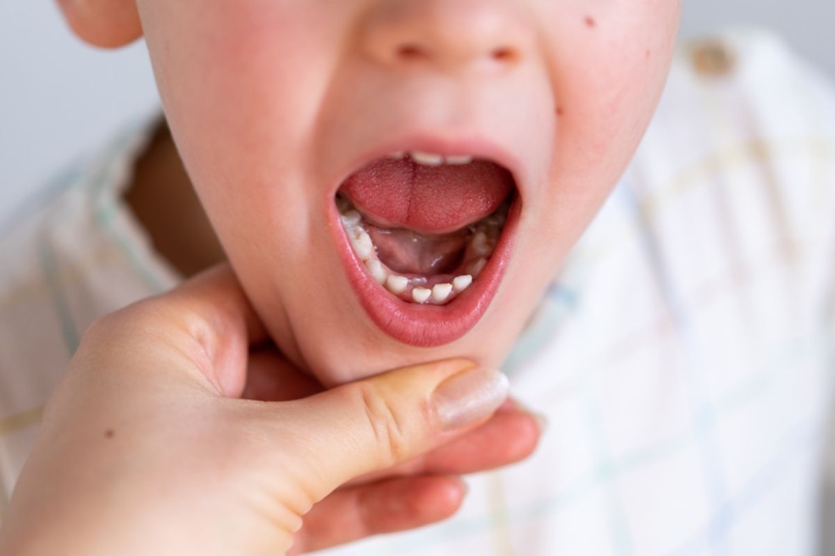 Simple Ways To Prevent Baby Bottle Tooth Decay