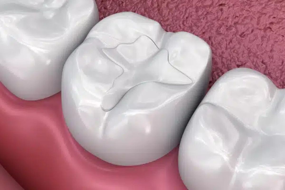 Top 3 Cosmetic Dental Issues Fixed with Bonding