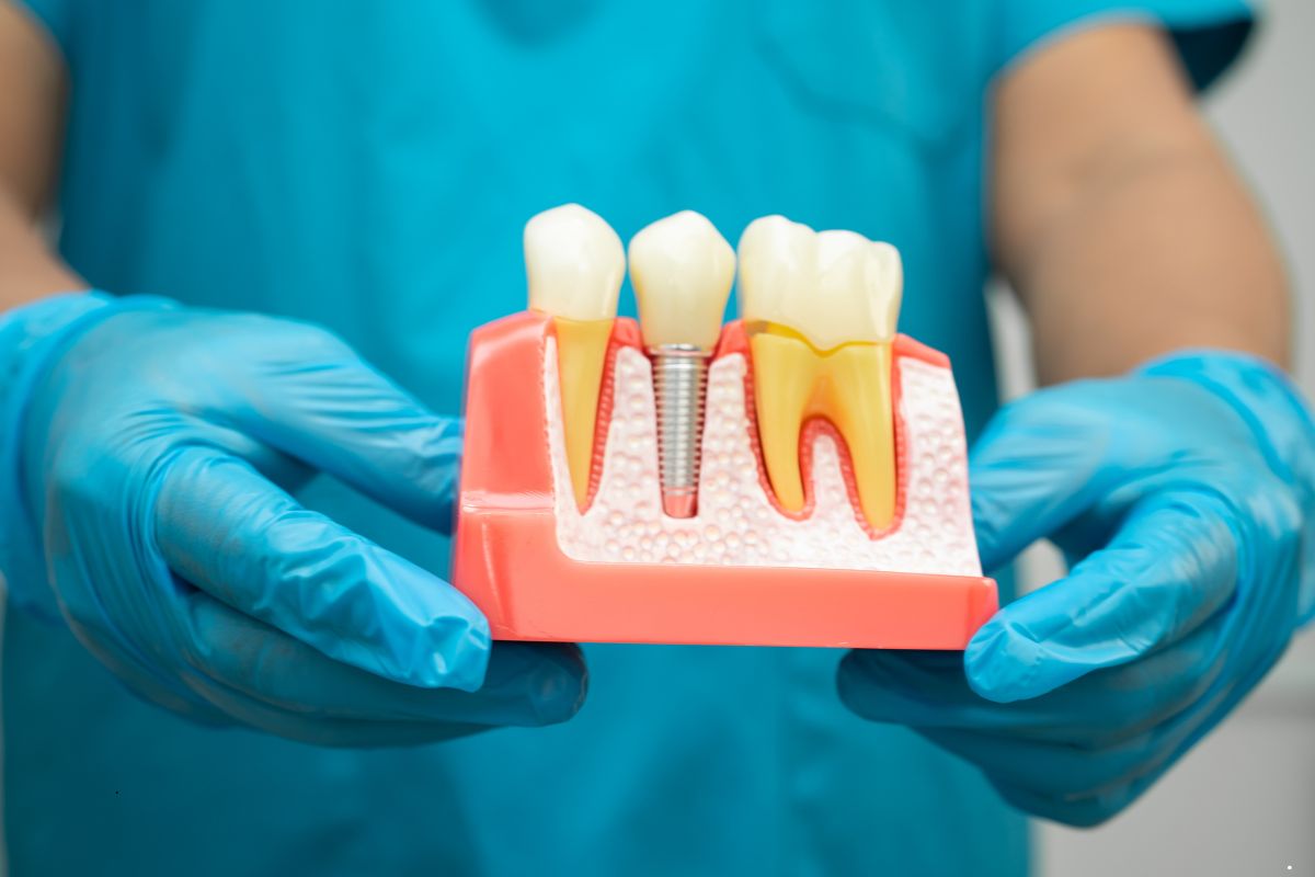 Are Dental Implants Right for You Here’s What to Know