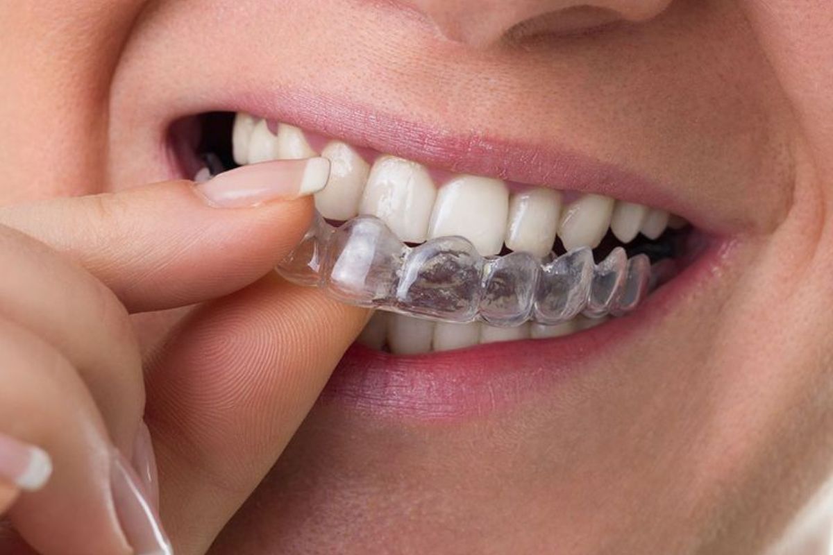 Give Yourself a Straighter Smile