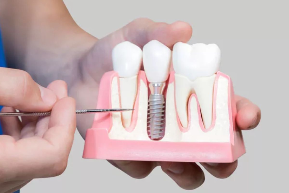 Signs That You Need Dental Implants