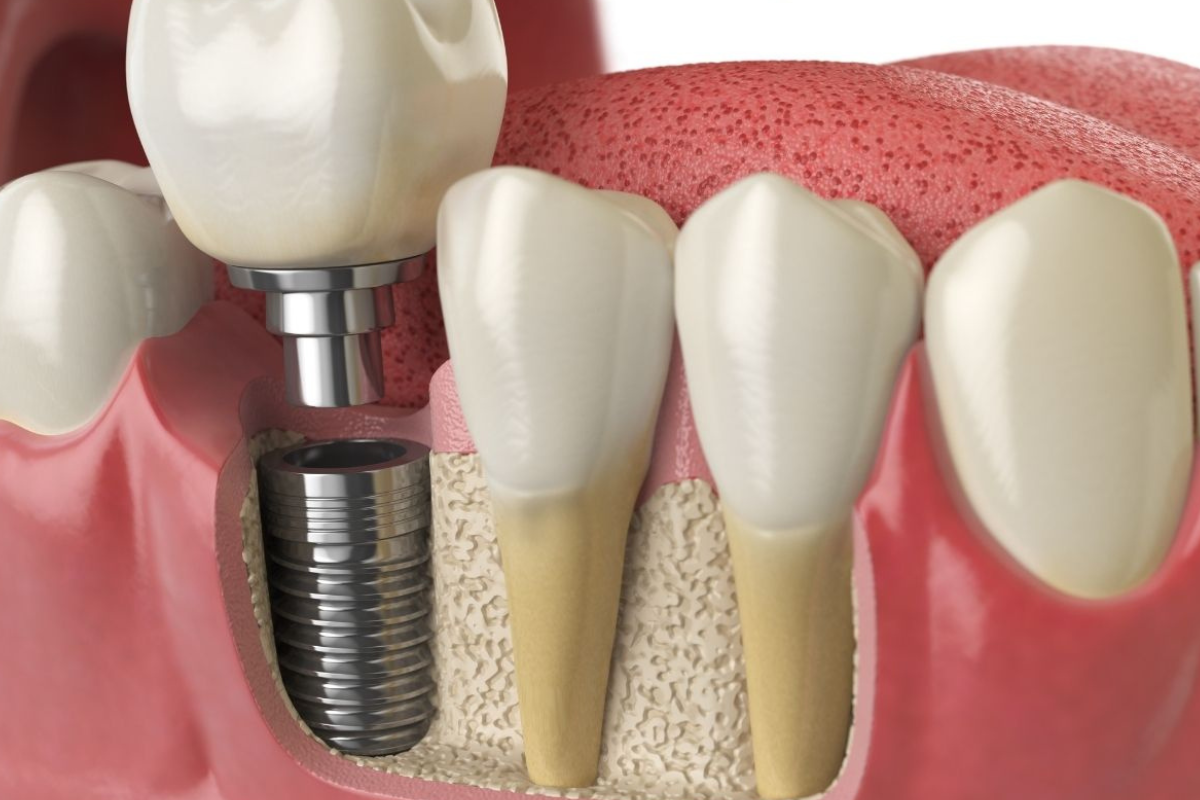 Dental Implants Raleigh