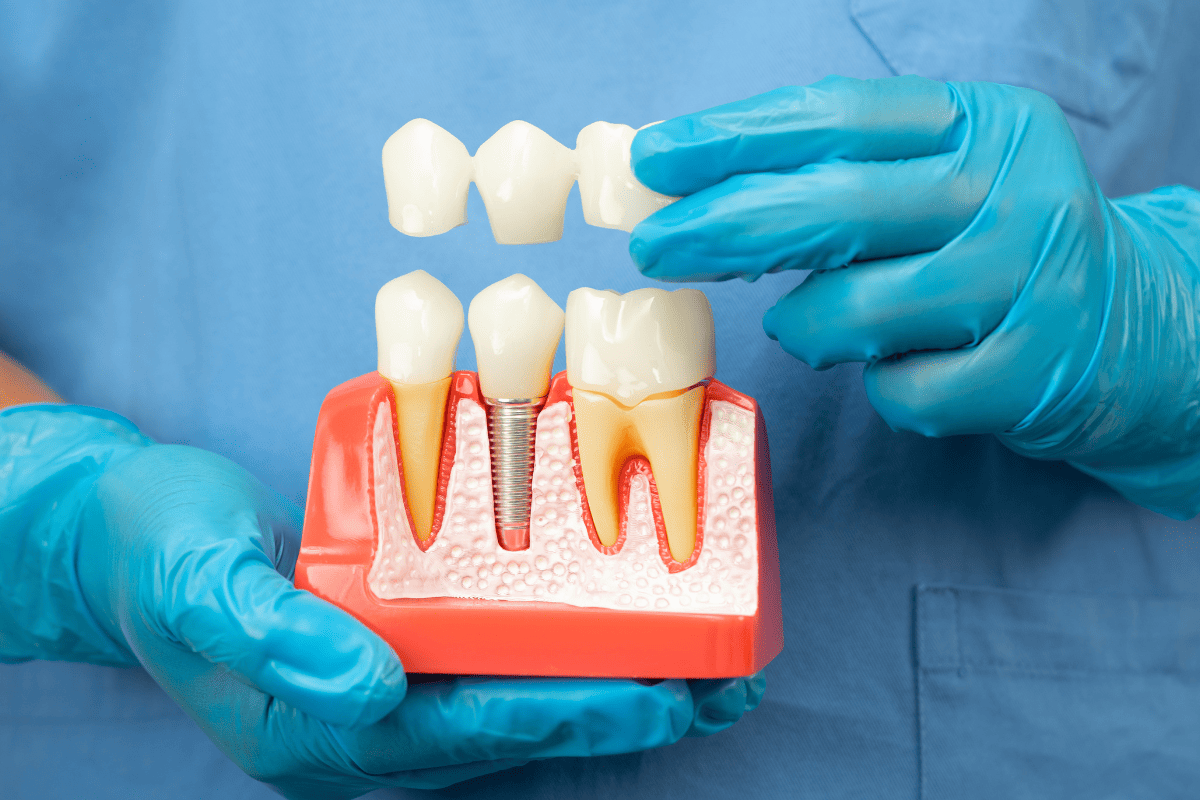 Dentist holding a dental implant model