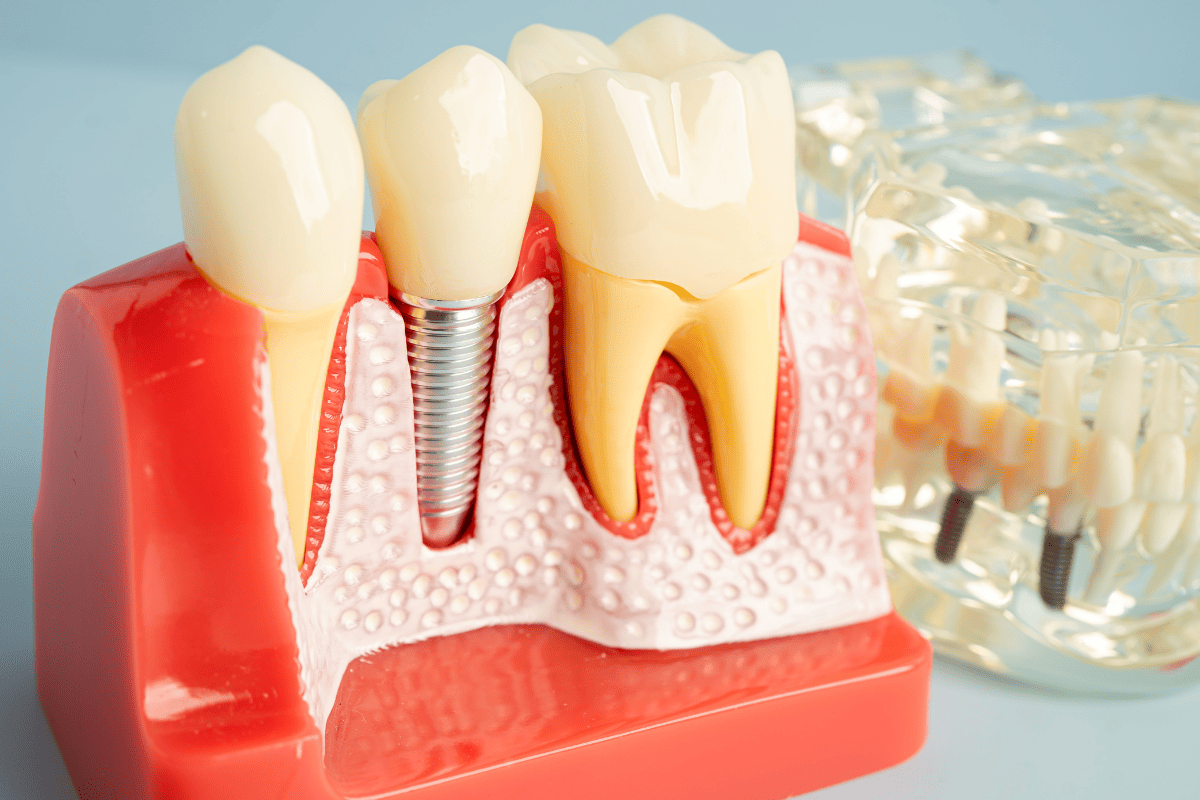 Model of dental implant
