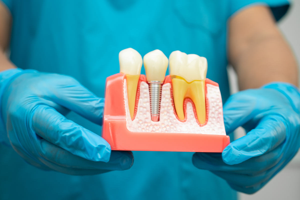 Dental Implants Raleigh